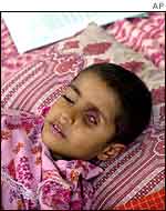 Child with eye tumour AP
