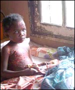 Hospital patient in Sambava