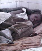 Malnourished girl in hospital, Angola