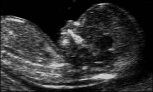 Babies were scanned in the womb