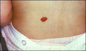 Small birthmark