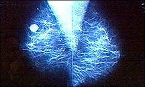 A family history of breast cancer could increase risk