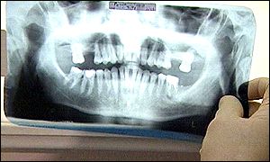 Ms Edwards had a broken tooth