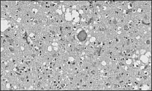Prions under microscope