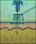 Insulin is delivered into the body via a tiny plastic tube (C) Medialink