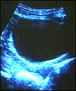 Ultrasound scan