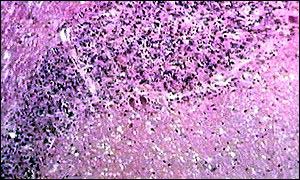 Tissue from a brain infected with vCJD