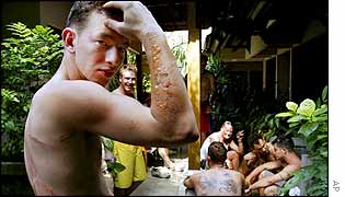 Australian football team member Adam Nimmo, 20, from Perth, Australia, shows the burns on his arm and back in Bali