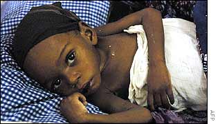 A starving Angolan child in a Luanda hospital