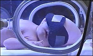 Baby Alannah Lewis being treated for jaundice, a side effect of Rhesus disease