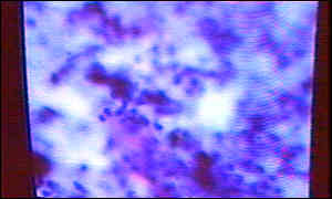 Cervical cancer smear