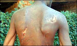 Torture victim in Zimbabwe
