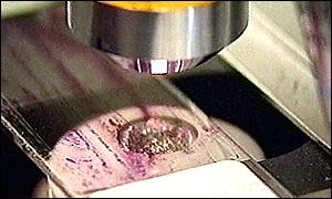 Cancer under microscope