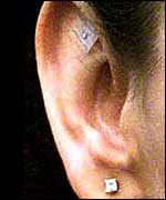 Acupuncture stud in top of ear