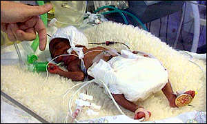 Premature baby