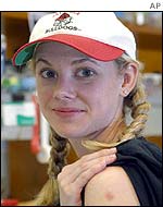 Student Elizabeth Forrester shows off smallpox scar