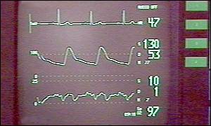 Heart monitor
