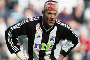 Newcastle striker Alan Shearer head is wrapped in bandages after a clash of heads