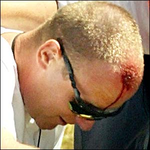 A supporter nurses a cut on his head after being struck by the ball from Sandy Lyle