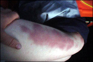 And the brave Briton does not escape without injury - this massive leg bruise is just one of the battle scars of the record attempt