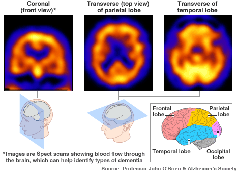 Brain with Alzheimer's disease