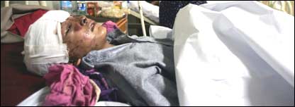 پمز میں داخل ایک زخمی بچہ