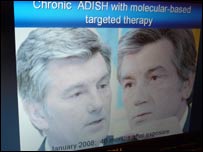 Фото 5 з доповіді професора: Віктор Ющенко після отруєння