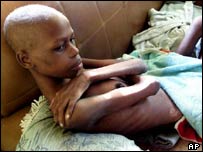 AIDS hastası bir Güney Afrikalı kadın