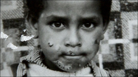 Scarred: Biadglign Befekadu was found suckling his dead mother while a vulture picked at their bodies.