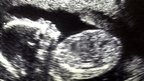Ultrasound scan of a foetus