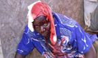An injured Zimbabwean refugee in Sochanguve Township