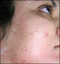 په مخ داغونه