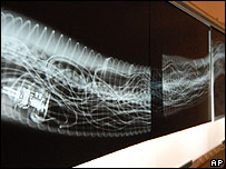 Os fios e controles do cobertor ficaram visíveis no raio-x