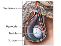 عقامت در مردها