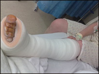 دهډوکي ماتېدل