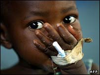 کودک آفریقایی که از سو تغذیه رنج می برد