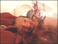 تولد قبل از وقت