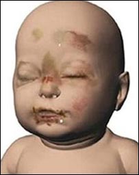 宝宝P伤势的计算机照片