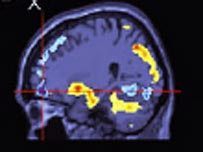 Ressonância magnética do cérebro. 