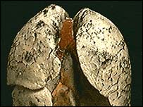 نمايی از ريه های مبتلا به سرطان 