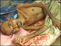 بيمار توبرکلوز