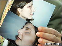 يک دختر قبل و بعد از عمل جراحی بينی