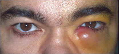 التهاب مکروبی چشم