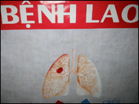 An Giang, HN, Hải Phòng, Tp HCM, Quảng Ninh là nơi đồng nhiễm HIV và lao cao