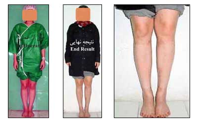 عمل افزایش قد