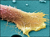 câncer de próstata