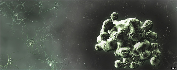Computer artwork of prion protein plaque