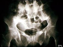 عکس رادیولوژی که علائم اوستیومالاسیا را نشان می دهد