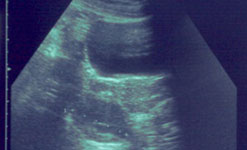 Ultrasound view of polycystic ovary cysts