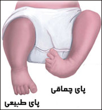 نرمی استخوان دراطفال